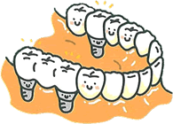歯を数本失ってしまった場合のインプラント